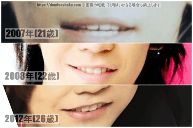 2007年(21歳当時)2008年(22歳当時)2012年(26歳当時)の亀梨和也の昔の口のアップを並べて歯の整形を検証した画像
