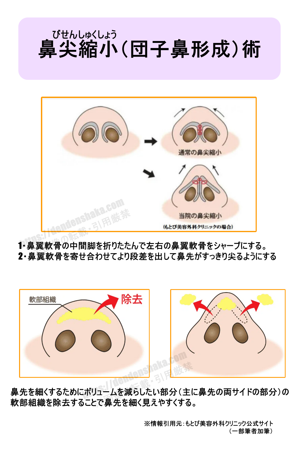 鼻尖縮小手術の手順と目的を説明した画像手順1・鼻翼軟骨の中間脚を折りたたんで左右の鼻翼軟骨をシャープにする。 手順2・鼻翼軟骨を寄せ合わせてより段差を出して鼻先がすっきり尖るようにする 手術目的:鼻先を細くするためにボリュームを減らしたい部分(主に鼻先の両サイドの部分)の 軟部組織を除去することで鼻先を細く見えやすくする ※情報引用元:もとび美容外科クリニック公式サイト (一部筆者加筆) https://dendenshaka.com ※画像の転載・引用厳禁