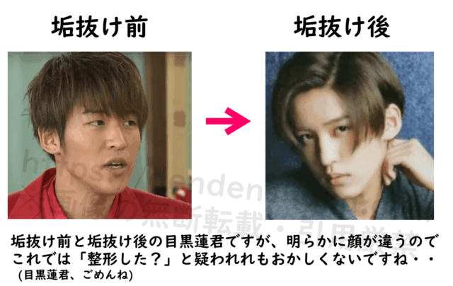 垢抜け前と垢抜け後の目黒蓮の写真を並べて比較。明らかに顔が違うのでこれでは「整形した？」と疑われれもおかしくないレベルであることを説明